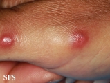 rosai-dorfman disease