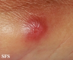 rosai-dorfman disease