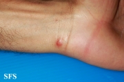 rosai-dorfman disease
