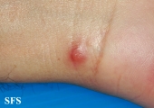 rosai-dorfman disease