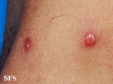 rosai-dorfman disease