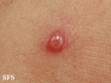 rosai-dorfman disease