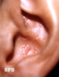 amyloidosis