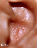 amyloidosis