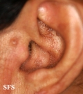 amyloidosis