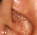 amyloidosis