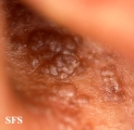 amyloidosis