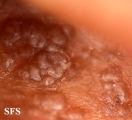 amyloidosis