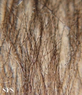 monilethrix