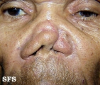 leishmaniasis-mucocutaneous leishmaniasis