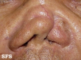leishmaniasis-mucocutaneous leishmaniasis
