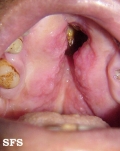 leishmaniasis-mucocutaneous leishmaniasis