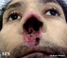 leishmaniasis-mucocutaneous leishmaniasis