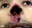 leishmaniasis-mucocutaneous leishmaniasis