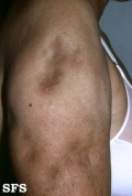lupus erythematosus profundus