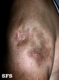 lupus erythematosus profundus