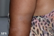 lupus erythematosus profundus