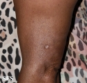 lupus erythematosus profundus
