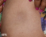 lupus erythematosus profundus