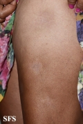 lupus erythematosus profundus