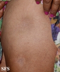 lupus erythematosus profundus