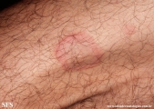 erythema annulare centrifugum
