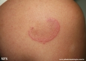 erythema annulare centrifugum