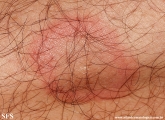 erythema annulare centrifugum