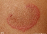 erythema annulare centrifugum