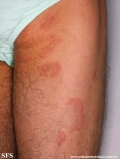 erythema annulare centrifugum
