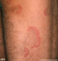 erythema annulare centrifugum