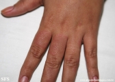 erythema annulare centrifugum