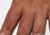 erythema annulare centrifugum