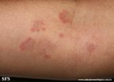 erythema annulare centrifugum