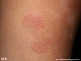 erythema annulare centrifugum