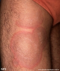 erythema annulare centrifugum