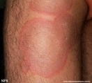 erythema annulare centrifugum