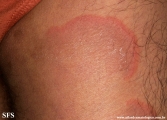 erythema annulare centrifugum
