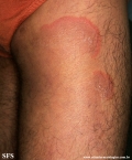 erythema annulare centrifugum