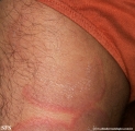 erythema annulare centrifugum