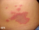 erythema annulare centrifugum
