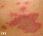 erythema annulare centrifugum