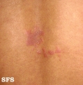 erythema annulare centrifugum