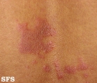 erythema annulare centrifugum