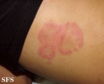 erythema annulare centrifugum