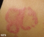 erythema annulare centrifugum
