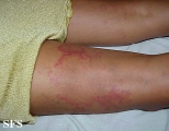erythema annulare centrifugum