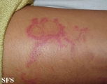 erythema annulare centrifugum