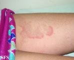 erythema annulare centrifugum