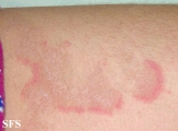 erythema annulare centrifugum